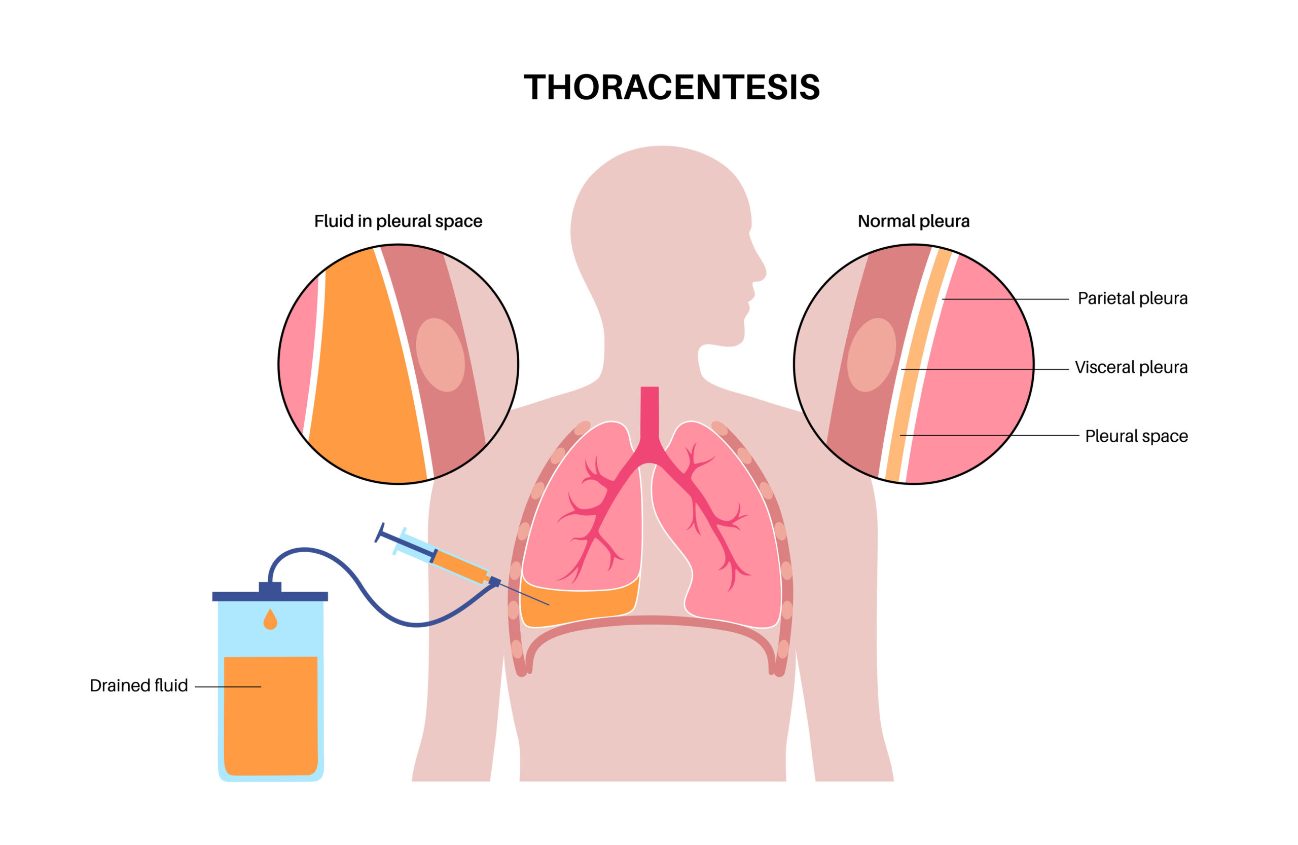 Thoracentesis